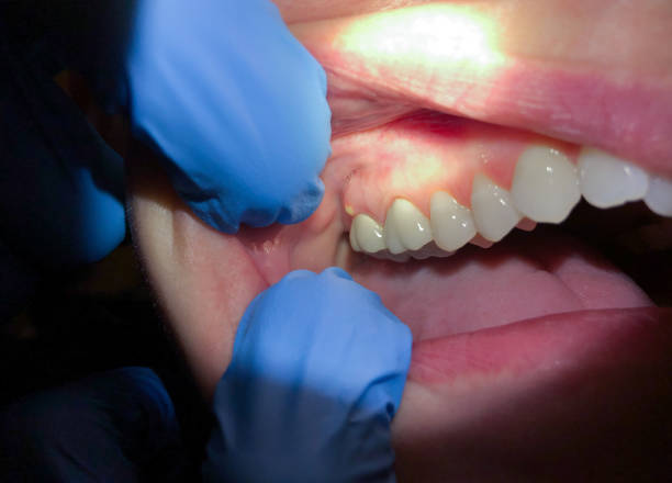 Best Emergency Wisdom Teeth Removal in Matta, WA